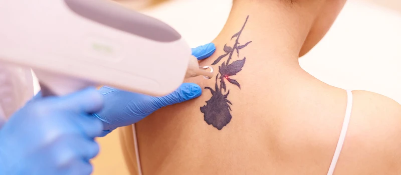 Laser tattoo removal treatment for a nape tattoo at Soluna Medical in Las Vegas