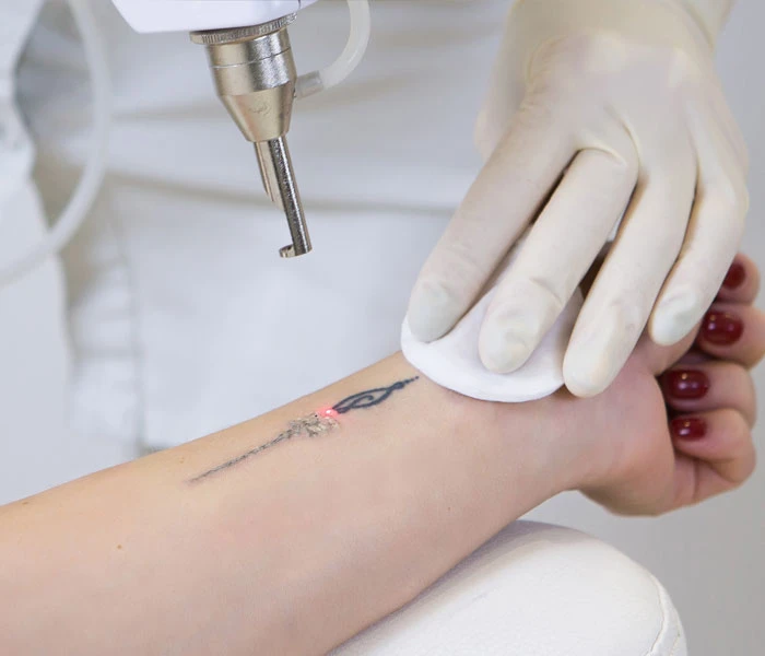 Laser tattoo removal treatment on a wrist tattoo at Soluna Medical in Las Vegas