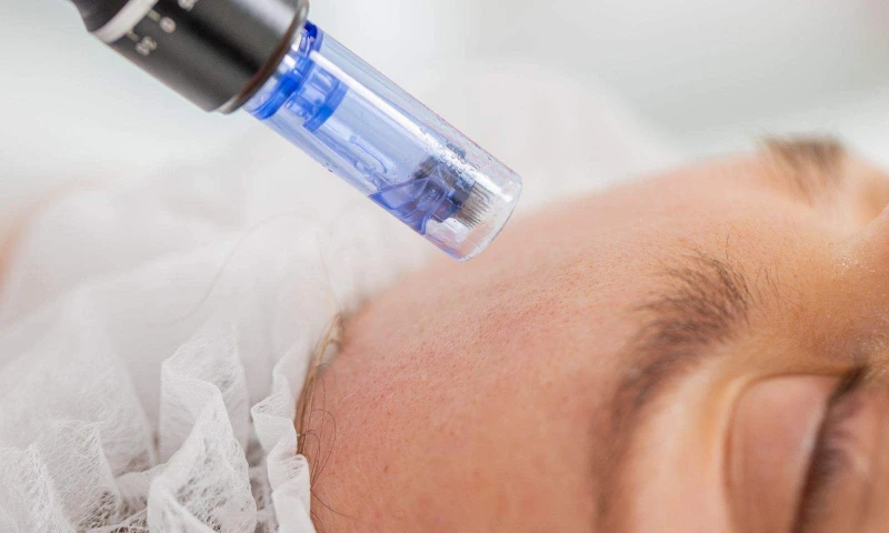 Professional facial microneedling treatment for skin rejuvenation at Soluna Medical in Las Vegas
