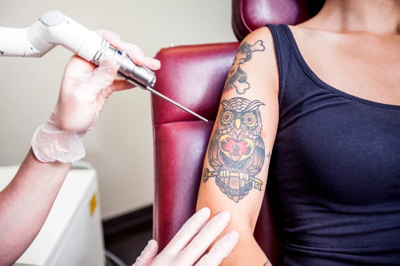 Woman receiving laser tattoo removal treatment on her arm at Soluna Medical in Las Vegas